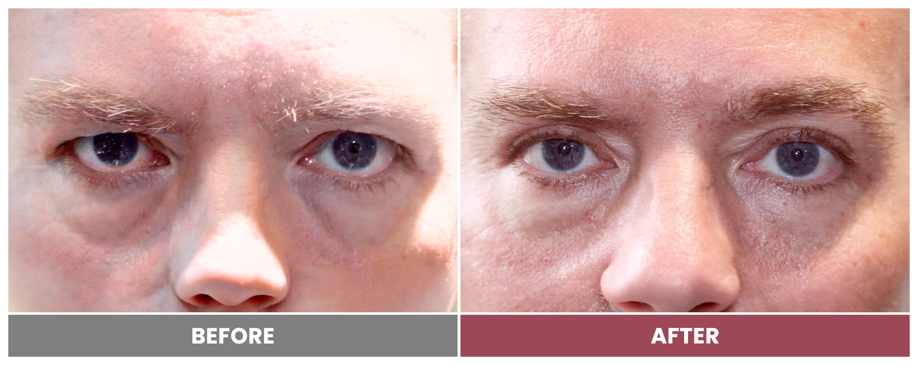 Upper Blepharoplasty - Case 38